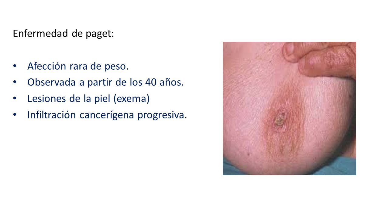Enfermedad de paget: Afección rara de peso. Observada a partir de los 40 años. Lesiones de la piel (exema)
