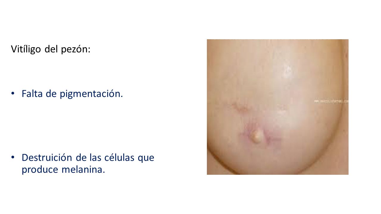 Vitíligo del pezón: Falta de pigmentación. Destruición de las células que produce melanina.