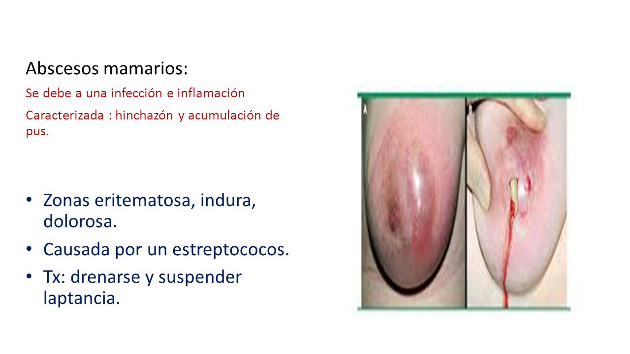 Zonas eritematosa, indura, dolorosa. Causada por un estreptococos.