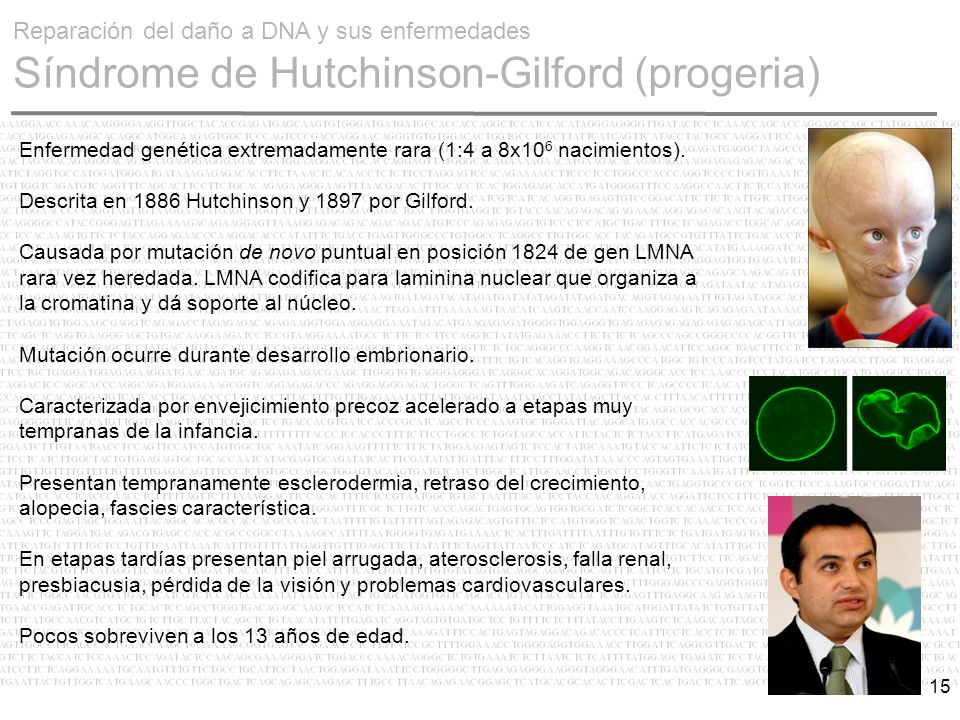 Reparación del daño a DNA y sus enfermedades Síndrome de Hutchinson-Gilford (progeria)