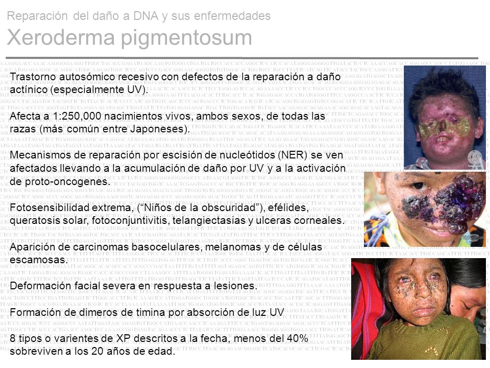 Reparación del daño a DNA y sus enfermedades Xeroderma pigmentosum