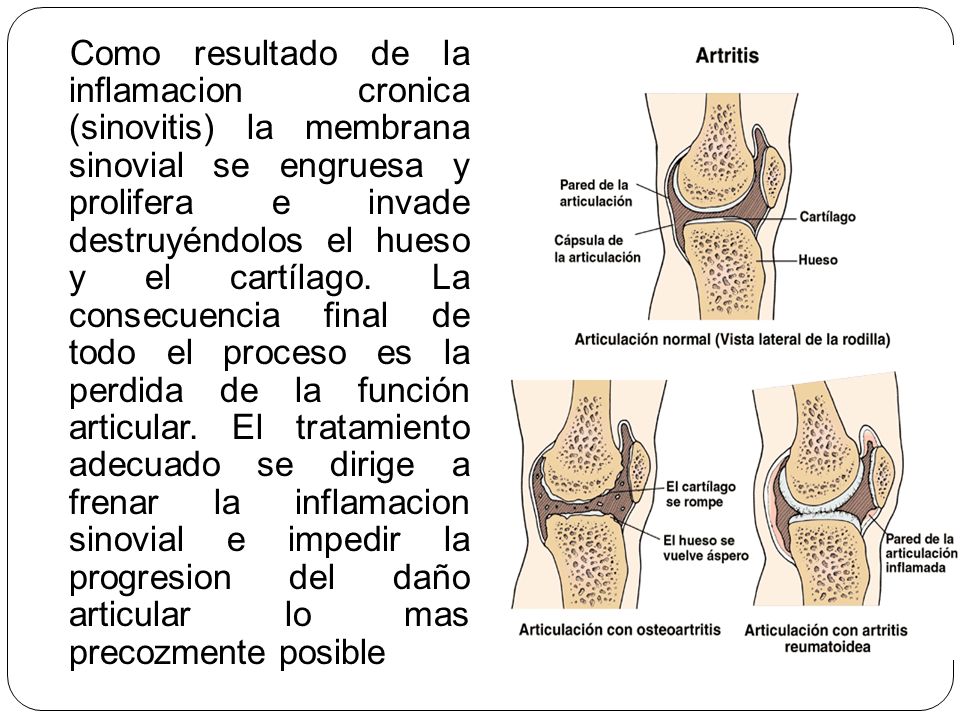 Como resultado de la inflamacion cronica (sinovitis) la membrana sinovial se engruesa y prolifera e invade destruyéndolos el hueso y el cartílago.