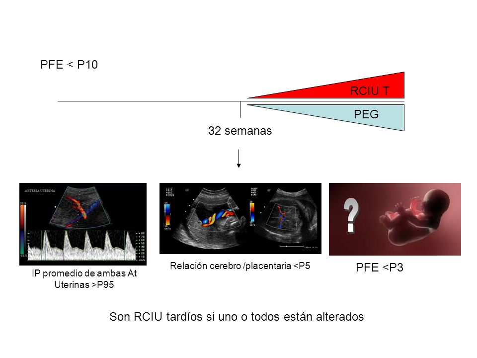 PFE < P10 RCIU T PEG 32 semanas PFE <P3