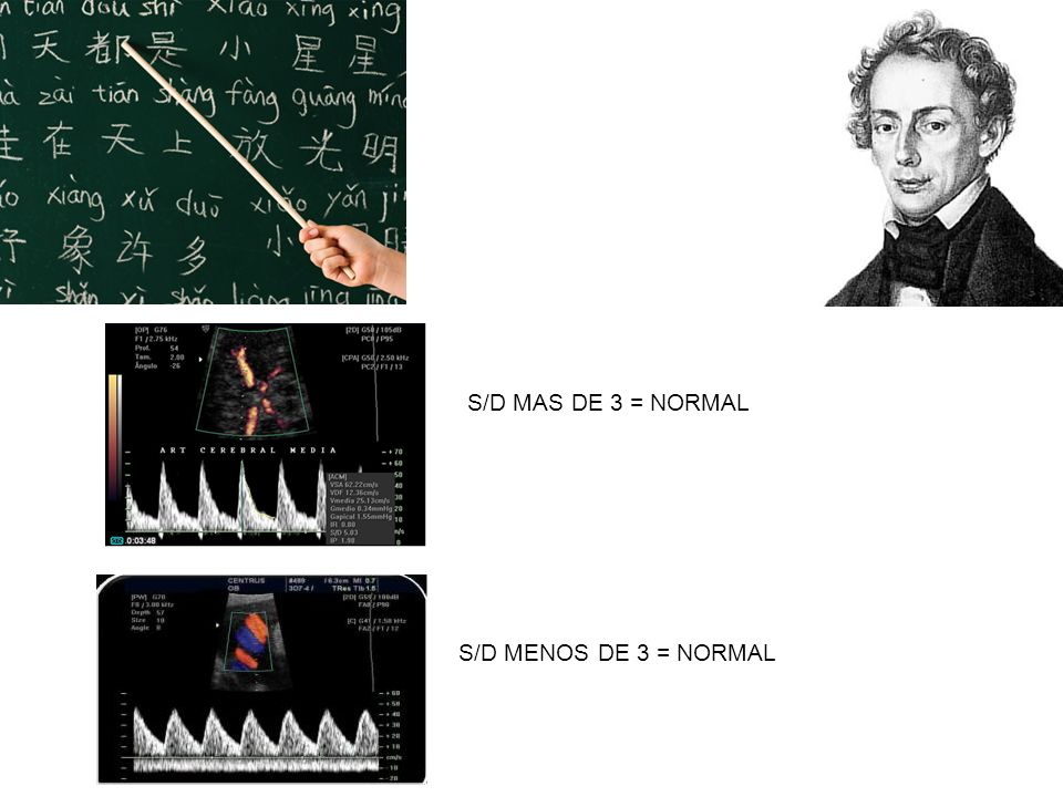 S/D MAS DE 3 = NORMAL S/D MENOS DE 3 = NORMAL