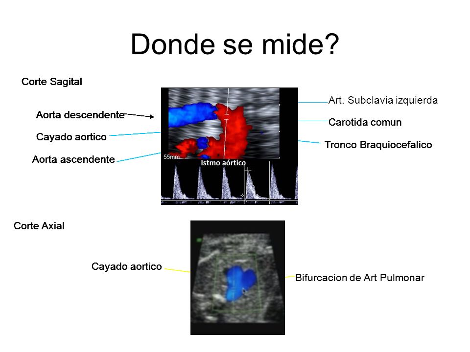 Donde se mide Corte Sagital Corte Sagital Corte Sagital Corte Sagital