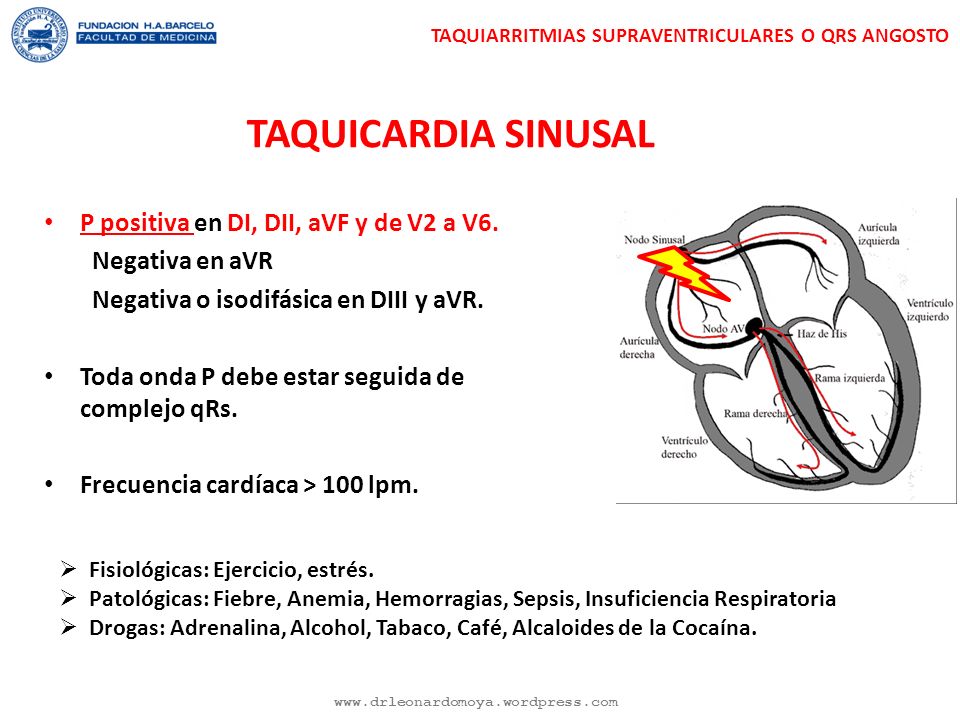 TAQUICARDIA SINUSAL P positiva en DI, DII, aVF y de V2 a V6.