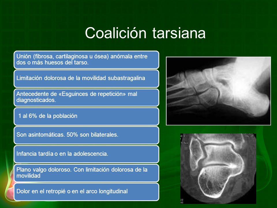 Coalición tarsiana Unión (fibrosa, cartilaginosa u ósea) anómala entre dos o más huesos del tarso.