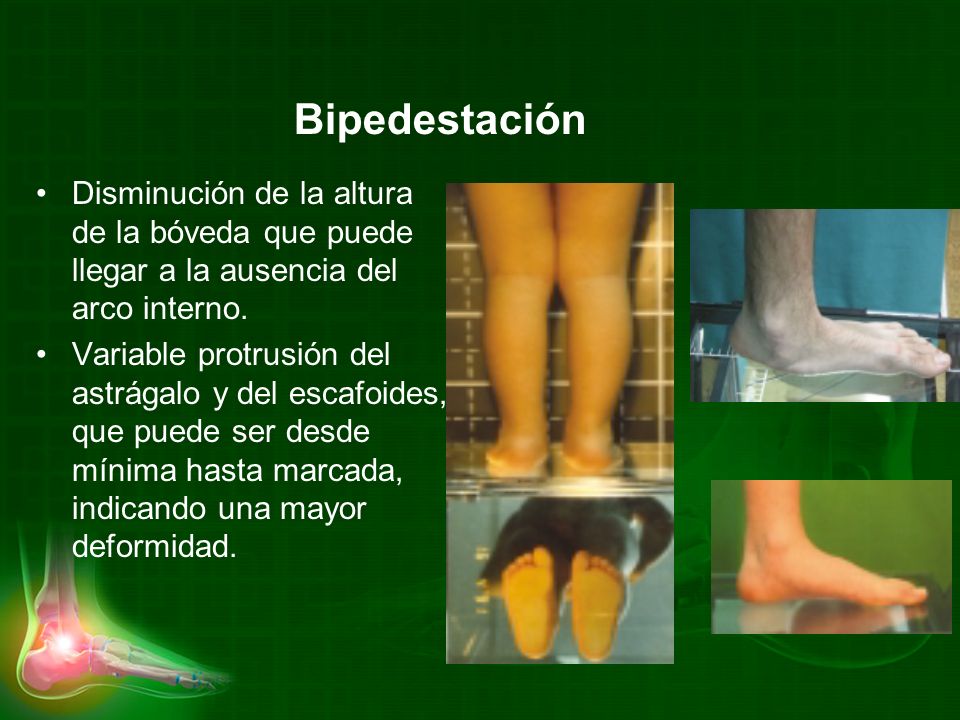 Bipedestación Disminución de la altura de la bóveda que puede llegar a la ausencia del arco interno.