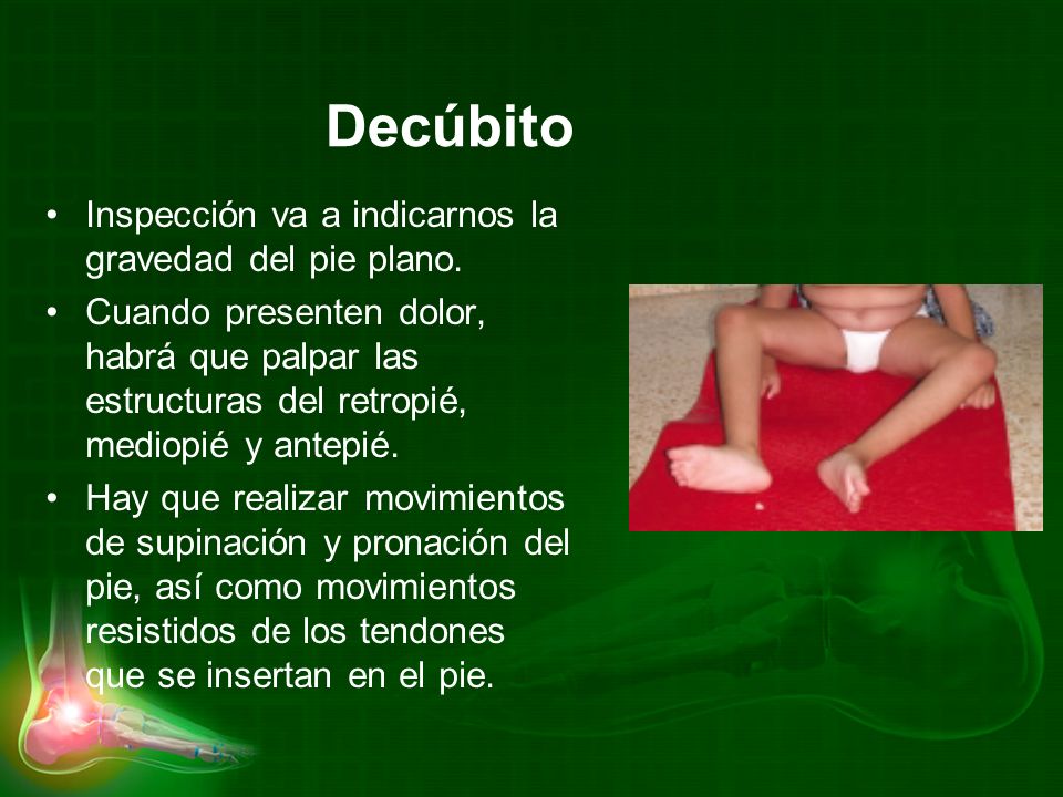 Decúbito Inspección va a indicarnos la gravedad del pie plano.