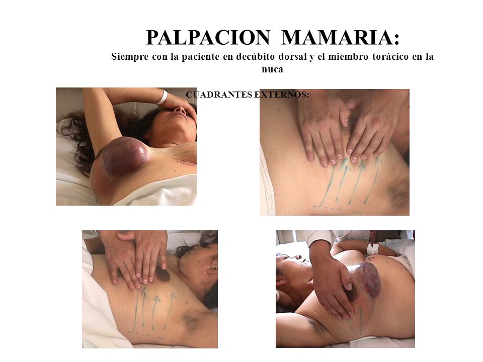 PALPACION MAMARIA: Siempre con la paciente en decúbito dorsal y el miembro torácico en la nuca