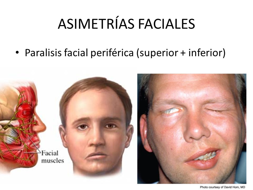ASIMETRÍAS FACIALES Paralisis facial periférica (superior + inferior)
