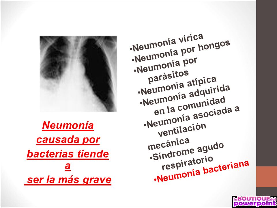 Neumonía causada por bacterias tiende a ser la más grave