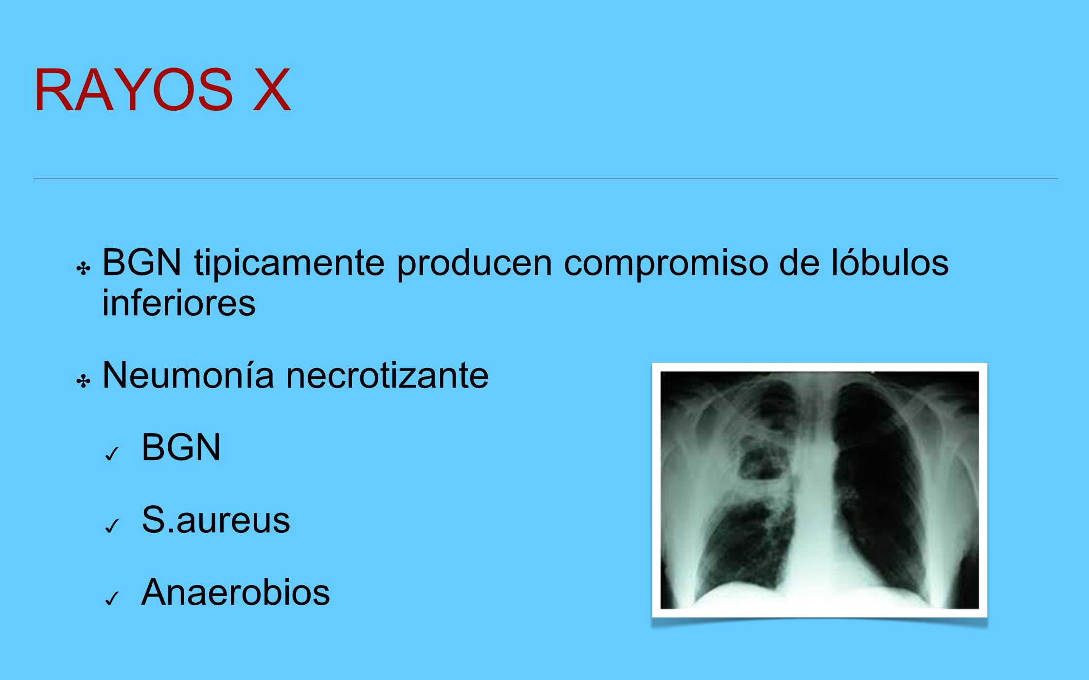 RAYOS X BGN tipicamente producen compromiso de lóbulos inferiores