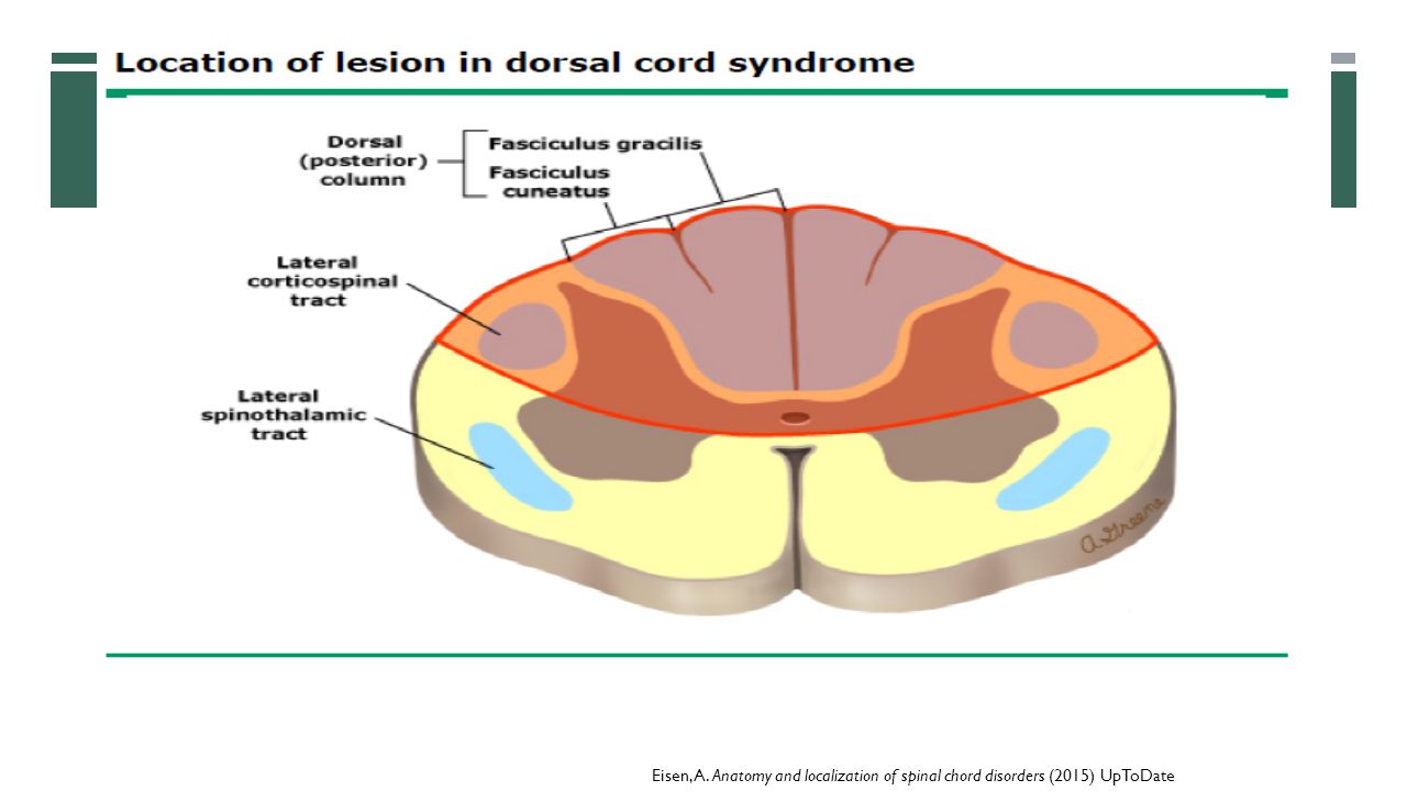 Eisen, A. Anatomy and localization of spinal chord disorders (2015) UpToDate