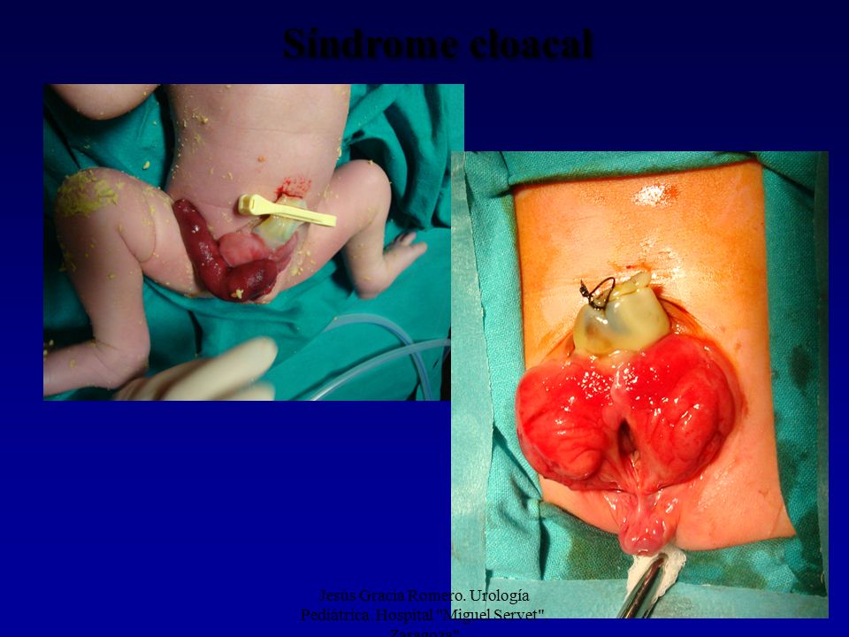 Síndrome cloacal Jesús Gracia Romero. Urología Pediátrica. Hospital Miguel Servet . Zaragoza