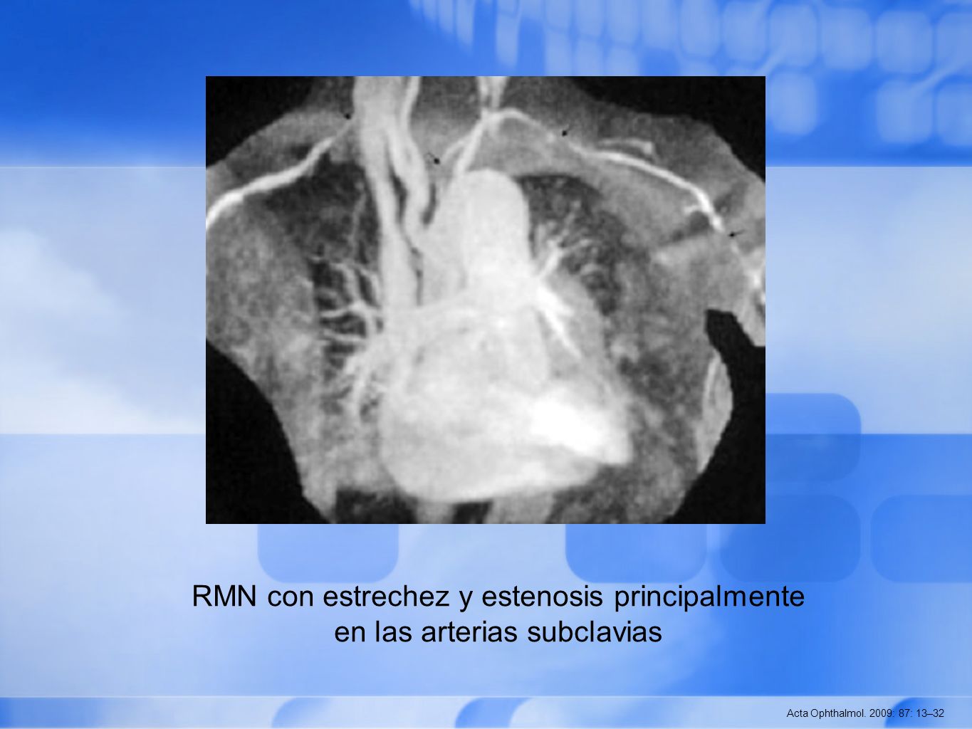 RMN con estrechez y estenosis principalmente en las arterias subclavias