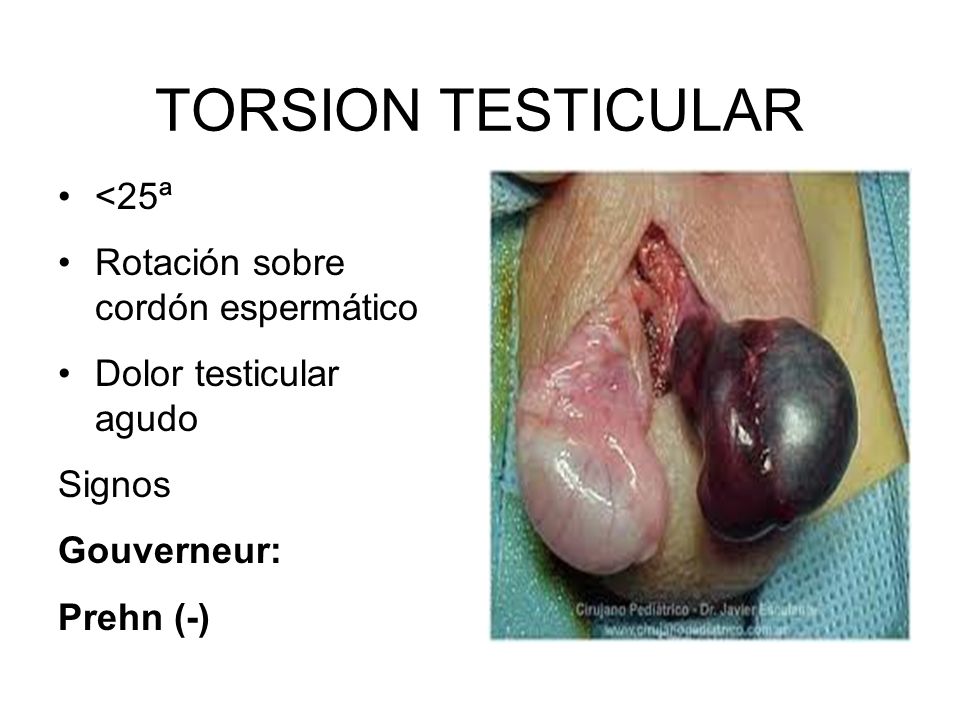TORSION TESTICULAR <25ª Rotación sobre cordón espermático