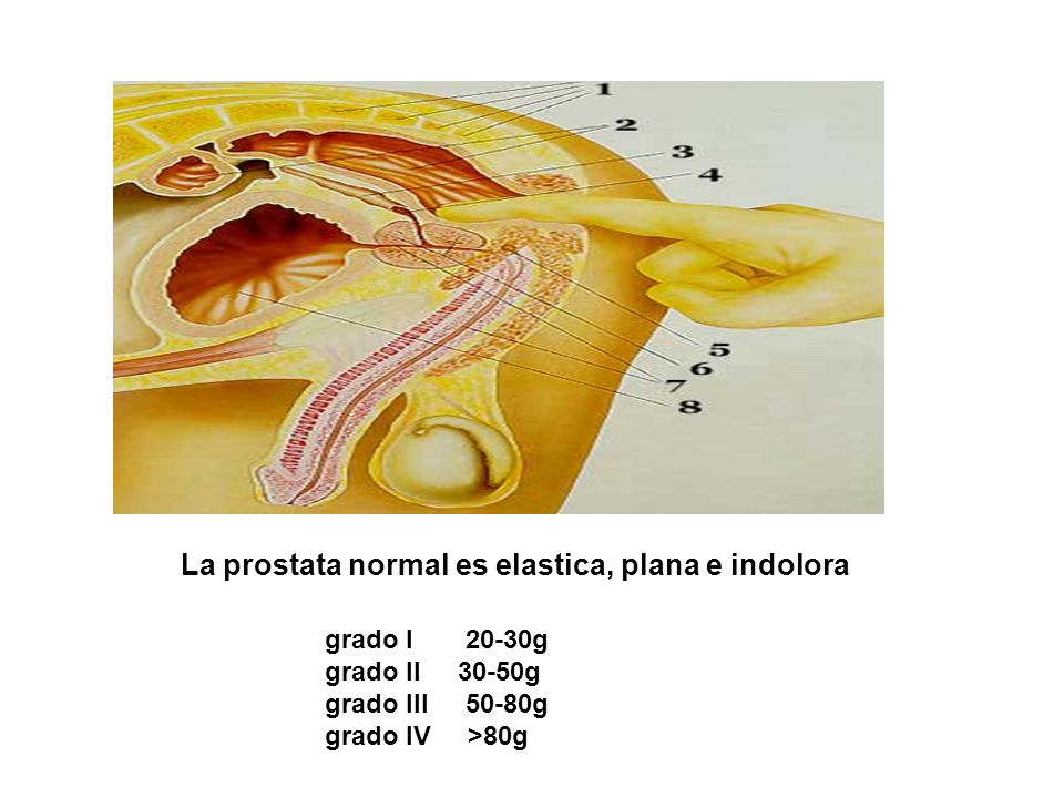 La prostata normal es elastica, plana e indolora