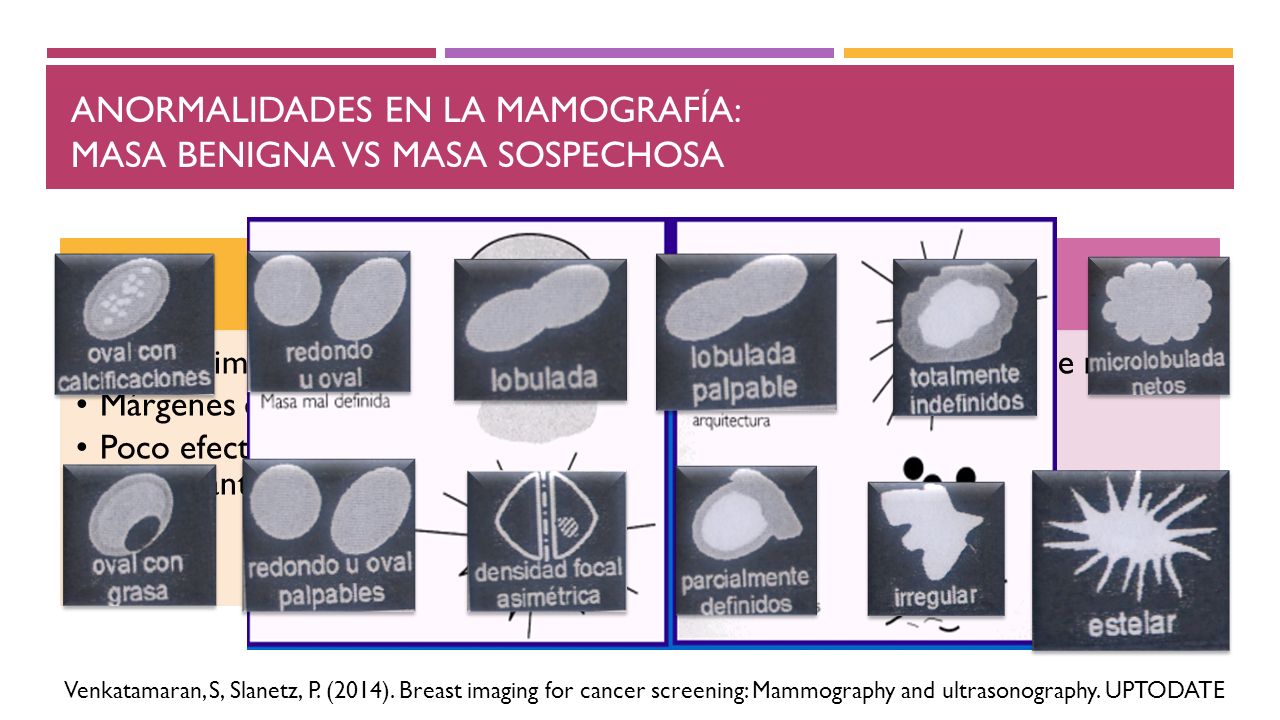 Anormalidades en la mamografía: masa benigna vs masa sospechosa