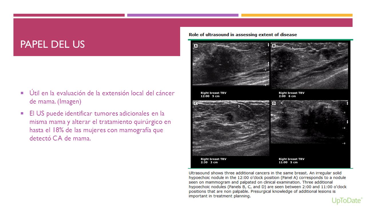 Papel del us Útil en la evaluación de la extensión local del cáncer de mama. (Imagen)