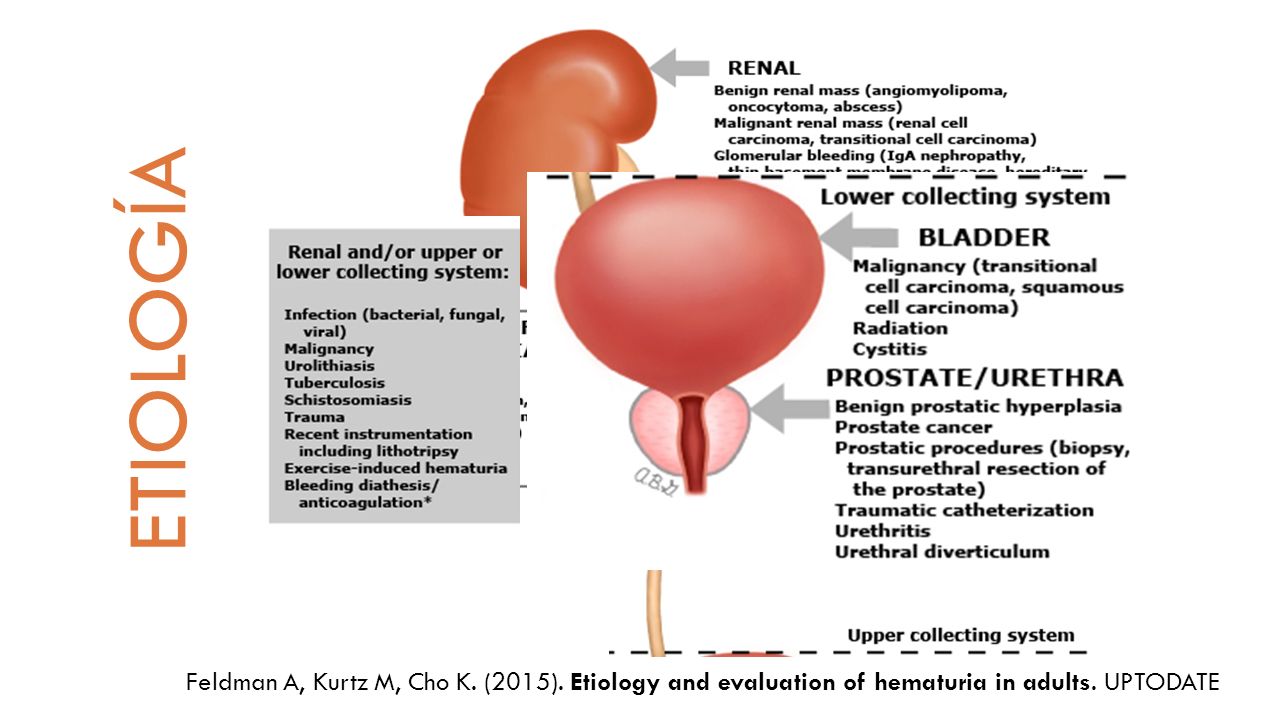 ETIOLOGÍA Feldman A, Kurtz M, Cho K. (2015). Etiology and evaluation of hematuria in adults.