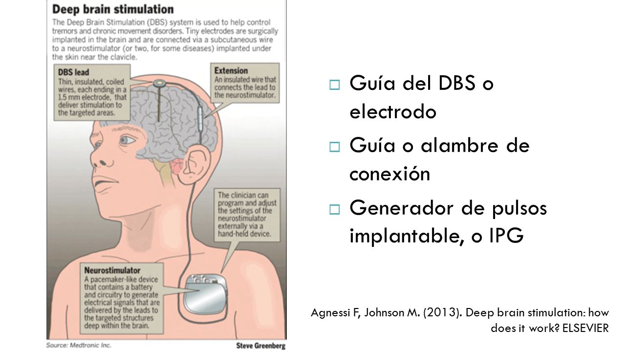Guía del DBS o electrodo Guía o alambre de conexión
