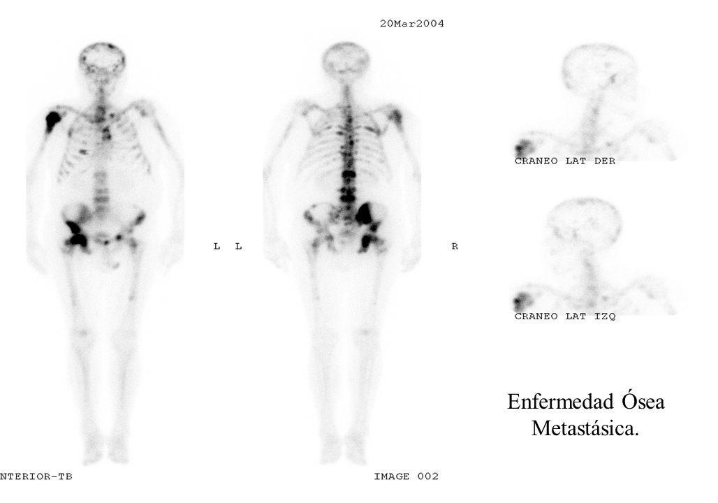 Enfermedad Ósea Metastásica.
