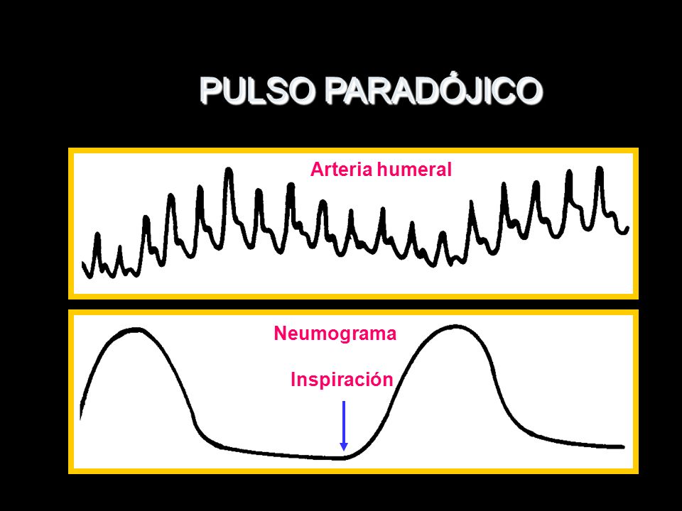 PULSO PARADÓJICO Arteria humeral Neumograma Inspiración