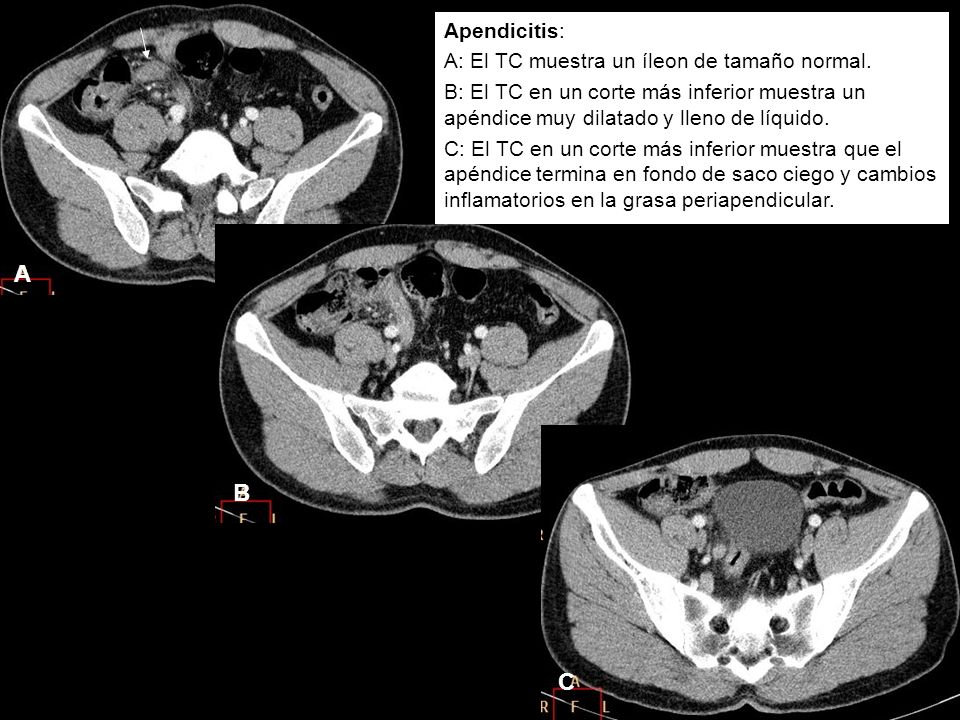 A B C Apendicitis: A: El TC muestra un íleon de tamaño normal.