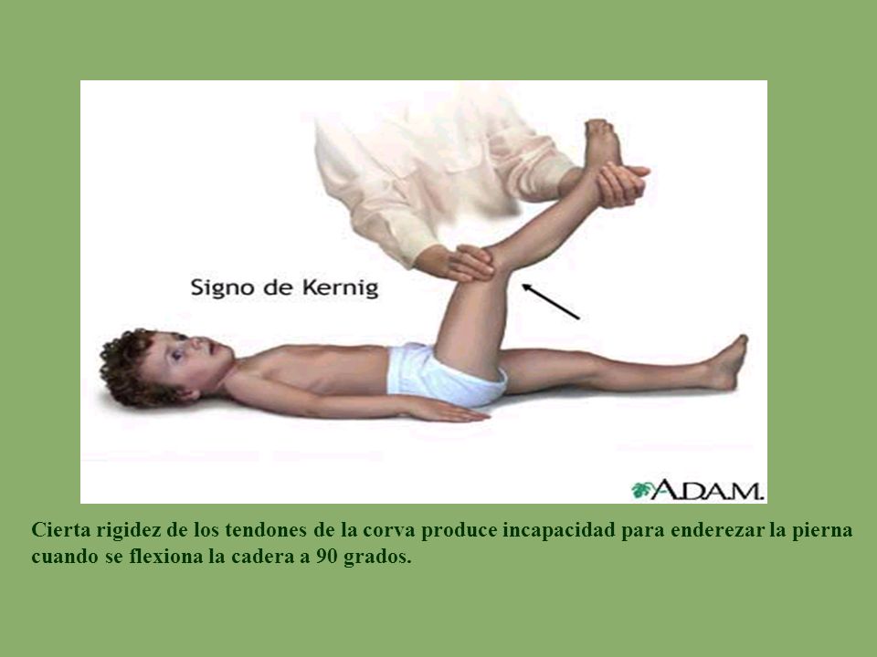 Cierta rigidez de los tendones de la corva produce incapacidad para enderezar la pierna cuando se flexiona la cadera a 90 grados.