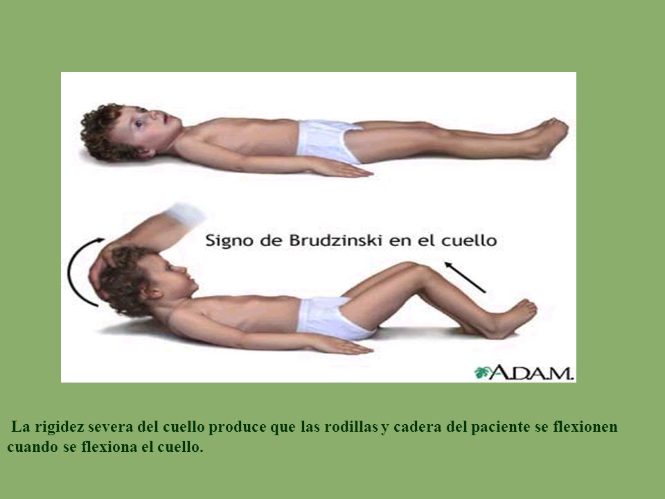 La rigidez severa del cuello produce que las rodillas y cadera del paciente se flexionen cuando se flexiona el cuello.