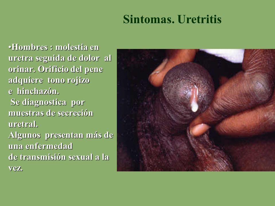 Hombres : molestia en uretra seguida de dolor al orinar
