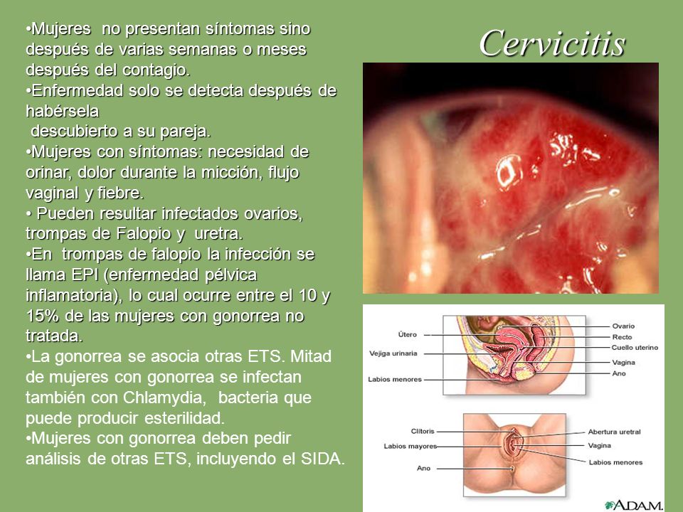 Mujeres no presentan síntomas sino después de varias semanas o meses después del contagio.