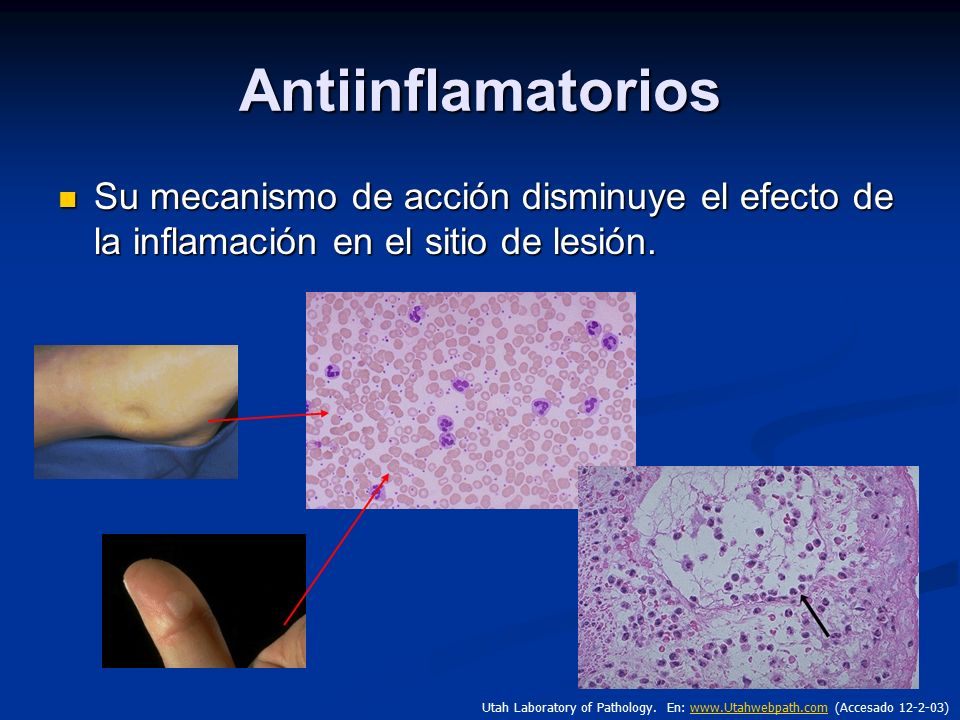Antiinflamatorios Su mecanismo de acción disminuye el efecto de la inflamación en el sitio de lesión.