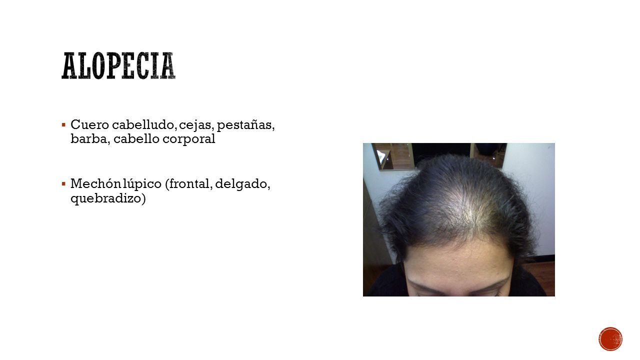alopecia Cuero cabelludo, cejas, pestañas, barba, cabello corporal