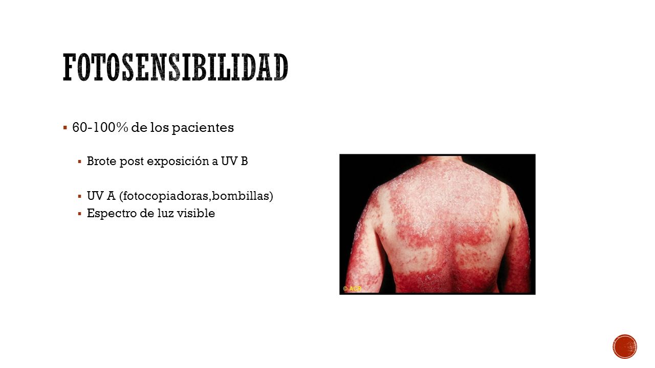 Fotosensibilidad % de los pacientes Brote post exposición a UV B