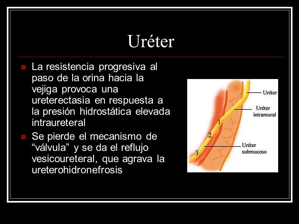 Estasis urinarias médico de término