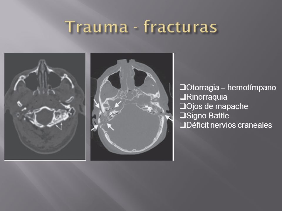 Trauma - fracturas Otorragia – hemotímpano Rinorraquia Ojos de mapache