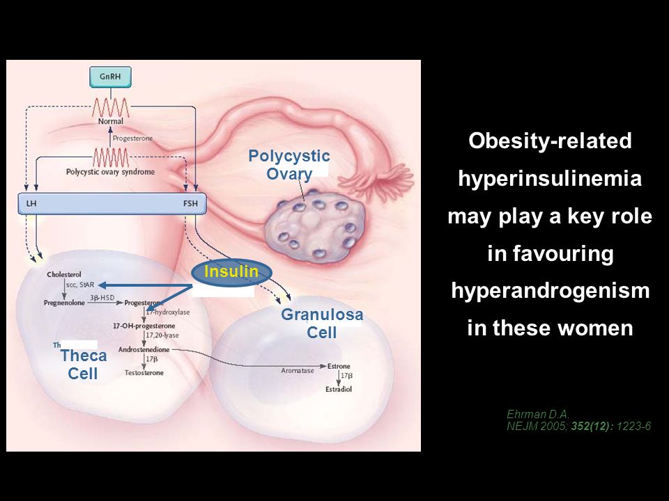 Obesity-related hyperinsulinemia may play a key role in favouring hyperandrogenism in these women