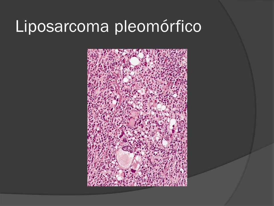 Liposarcoma pleomórfico